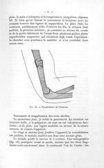 Fig. 18. Pseudarthrose de l'humérus - Avril 1907. Titres et travaux scientifiques
