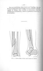 Fig. 19. Fracture oblique du tibia avant les tentatives de réduction - Avril 1907. Titres et travaux [...]