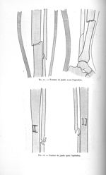 Fig. 22. Fracture de jambe avant l'opération / Fig. 23. Fracture jambe après l'opération - Avril 190 [...]