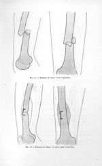 Fig. 24. Fracture du fémur avant l'opération / Fig. 25. Fracture du fémur, 30 jours après l'opératio [...]