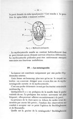 Fig. 4. Myélocysto-méningocèle - Titres et travaux scientifiques