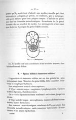 Fig. 5. Méningocèle - Titres et travaux scientifiques