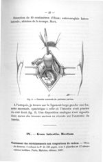 Fig. 6. Fossette anormale du péritoine pelvien - Titres et travaux scientifiques