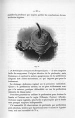Fig. 12. [Laparatomie, utérus gangrené et perforé] - Titres et travaux scientifiques