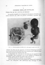 Fig. 73. Grossesse gémellaire bivitelline avec 2 oeufs séparés - Exposé des titres et travaux scient [...]