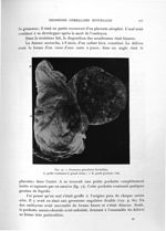 Fig. 74. Grossesse gémellaire bivitelline - Exposé des titres et travaux scientifiques
