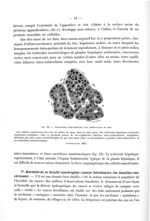 Fig. 24. Végétations intra-portales d'un adéno-cancer du foie - Titres et travaux scientifiques et t [...]