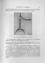 Fig. 29. Appareil à extension pour les fractures de l'humérus - Exposé des travaux scientifiques