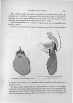 Fig. 103. Par l'incision, on voit le fond de l'utérus / Fig. 104. Coupe montrant les rapports avec l [...]