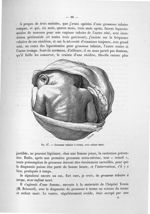 Fig. 27. Grossesse tubaire à terme, avec enfant mort - Titres et travaux scientifiques