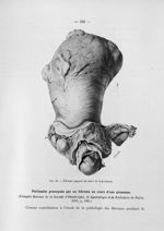 Fig. 60. Fibrome suppuré au cours de la grossesse - Titres et travaux scientifiques