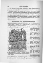 Fig. 20. Epithéliome de la mâchoire - Exposé des travaux scientifiques
