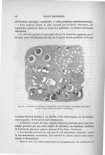 Fig. 25. Portion de la substance corticale dans un cas de néphrite ascendante colibacillaire avec de [...]