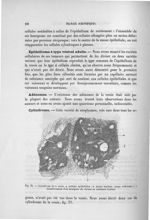 Fig. 35. Cylindrome de la vessie - Exposé des travaux scientifiques