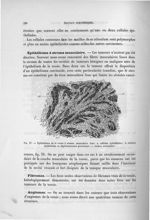 Fig. 37. Epithélioma de la vessie à stroma musculaire lisse - Exposé des travaux scientifiques