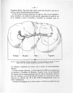 Fig. 23. Dessin schématique (grandeur demi-nature) de la face inférieure du sarcome de l'ovaire gauc [...]
