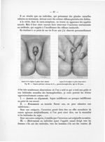 Fig. 28. Organes génitaux externes de O..., pseudo-hermaphrodite, âgé de 26 jours - Notice sur les t [...]