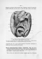 Fig. 31. Double anévrysme du ventricule gauche (réduction de 1/3) - Notice sur les travaux scientifi [...]