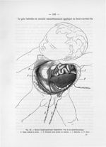 Fig. 32. Hernie diaphragmatique congénitale. Vue de la cavité thoracique - Notice sur les travaux sc [...]