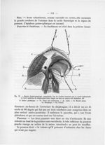Fig. 33. Hernie diaphragmatique congénitale. Vue de l'orifice herniaire par la cavité abdominale - N [...]