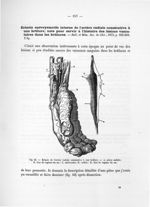 Fig. 44. Ectasie de l'artère radiale consécutive à une brûlure - Notice sur les travaux scientifique [...]