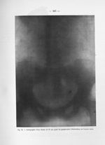 Fig. 52. Radiographie d'une femme de 57 ans ayant un pseudo-calcul (Phlébolithes) de l'uretère droit [...]