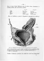 Fig. 54. Préparation de la vessie et de l'uretère droit, ouverts par leur face postérieure - Notice  [...]