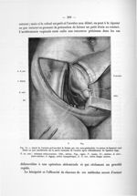 Fig. 55. Abord de l'uretère pelvien chez la femme par voie sous-péritonéale - Notice sur les travaux [...]