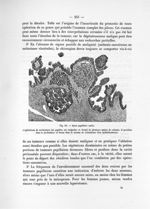 Fig. 66. Kyste papillaire malin - Notice sur les travaux scientifiques