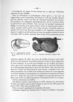 Fig. 74. Salpingorrhaphie. Pavillon de la trompe étalé et fixé sur l'ovaire / Fig. 75. Micro-kyste s [...]