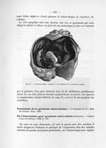 Fig. 77. Grossesse tubaire (embryon de 21 millimètres) ; la poche est ouverte - Notice sur les trava [...]