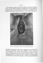 Fig. 82. Placement des fils de suture ; les fils commissuraux sont tordus - Notice sur les travaux s [...]