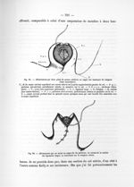 Fig. 85. Affrontement par deux plans de suture continue au catgut des lambeaux du moignon (tissu mus [...]