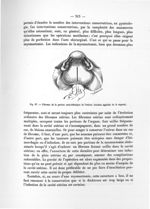 Fig. 87. Fibrome de la portion sous-isthmique de l'utérus (Incision sagittale de la capsule) - Notic [...]