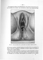 Fig. 96. Tracé des incisions dans la périnéorraphie pour déchirure complète du périnée - Notice sur  [...]