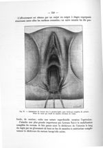Fig. 97. Abaissement du rectum dans la périnéorraphie pour déchirure complète du périnée - Notice su [...]