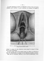 Fig. 98. Abaissement du rectum et myorraphie des muscles releveurs de l'anus - Notice sur les travau [...]