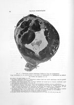Fig. 3. Grossesse tubaire isthmique - Titres et travaux scientifiques