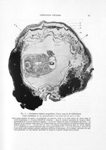 Fig. 4. Grossesse tubaire ampullaire - Titres et travaux scientifiques