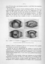 Fig. 4. Résultats de la stomatoplastie pour étroitesse congénitale du col observés plusieurs années  [...]