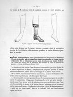 Fig. 17. Appareil contre le pied bot équin paralytique - Supplément. Notice sur les travaux scientif [...]
