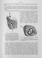 Fig. 91. Coupe du poumon montrant un anévrisme rompu dans une petite caverne / Fig. 92. Coupe du pou [...]