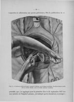 Fig. 4. L'utérus a été sectionné jusqu'à l'isthme, sur la ligne médiane - Titres et travaux scientif [...]