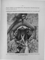 Fig. 9. Décollation postérieure : L'utérus est attiré en avant - Titres et travaux scientifiques