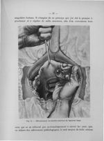Fig. 11. Effondrement du feuillet antérieur du ligament large - Titres et travaux scientifiques