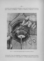 Fig. 16. Section des ligaments ronds et du péritoine antérieur - Titres et travaux scientifiques