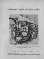 Fig. 19. Le col est attiré en avant et l'utérus est renversé - Titres et travaux scientifiques