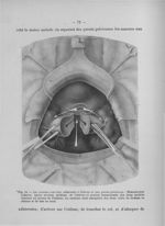Fig. 24. Les annexes sont très adhérentes à l'utérus et aux parois pelviennes : Hémisection utérine  [...]