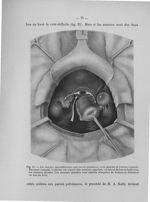 Fig. 25. Les annexes sont adhérentes aux parois pelviennes, mais séparées de l'utérus à gauche - Tit [...]