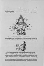 Fig. 2. Dernières vertèbres céphaliques et premières vertèbres cervicales / Fig. 3. Soudure congénit [...]